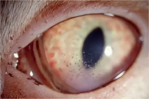 kedi göz enfeksiyonu - Üveit